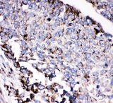 AEBP2 Antibody - IHC analysis of AEBP2 using anti-AEBP2 antibody. AEBP2 was detected in paraffin-embedded section of human lung cancer tissues. Heat mediated antigen retrieval was performed in citrate buffer (pH6, epitope retrieval solution) for 20 mins. The tissue section was blocked with 10% goat serum. The tissue section was then incubated with 1µg/ml rabbit anti-AEBP2 Antibody overnight at 4°C. Biotinylated goat anti-rabbit IgG was used as secondary antibody and incubated for 30 minutes at 37°C. The tissue section was developed using Strepavidin-Biotin-Complex (SABC) with DAB as the chromogen.