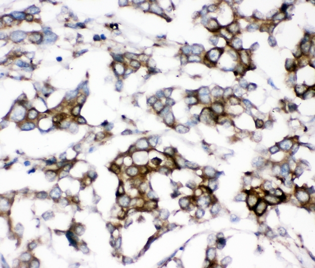 AEBP2 Antibody - IHC analysis of AEBP2 using anti-AEBP2 antibody. AEBP2 was detected in paraffin-embedded section of human mammary cancer tissues. Heat mediated antigen retrieval was performed in citrate buffer (pH6, epitope retrieval solution) for 20 mins. The tissue section was blocked with 10% goat serum. The tissue section was then incubated with 1µg/ml rabbit anti-AEBP2 Antibody overnight at 4°C. Biotinylated goat anti-rabbit IgG was used as secondary antibody and incubated for 30 minutes at 37°C. The tissue section was developed using Strepavidin-Biotin-Complex (SABC) with DAB as the chromogen.