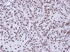 AEN Antibody - IHC of paraffin-embedded Cal27 Xenograft using Apoptosis-enhancing nuclease antibody at 1:100 dilution.