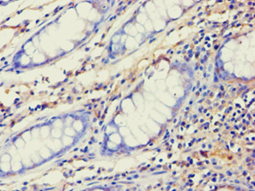 AES / Groucho Antibody - Immunohistochemistry of paraffin-embedded human colon cancer using antibody at 1:100 dilution.