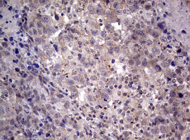 AFAP1 / AFAP Antibody - IHC of paraffin-embedded Adenocarcinoma of Human ovary tissue using anti-AFAP1 mouse monoclonal antibody. (Heat-induced epitope retrieval by 10mM citric buffer, pH6.0, 120°C for 3min).