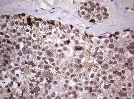 AFAP1 / AFAP Antibody - IHC of paraffin-embedded Adenocarcinoma of Human breast tissue using anti-AFAP1 mouse monoclonal antibody. (Heat-induced epitope retrieval by 10mM citric buffer, pH6.0, 120°C for 3min).