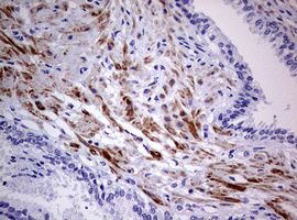 AFAP1 / AFAP Antibody - IHC of paraffin-embedded Carcinoma of Human prostate tissue using anti-AFAP1 mouse monoclonal antibody. (Heat-induced epitope retrieval by 10mM citric buffer, pH6.0, 120°C for 3min).