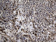 AFAP1 / AFAP Antibody - Immunohistochemical staining of paraffin-embedded Human lymphoma tissue using anti-AFAP1 mouse monoclonal antibody. (Heat-induced epitope retrieval by 1mM EDTA in 10mM Tris buffer. (pH8.5) at 120°C for 3 min. (1:2000)