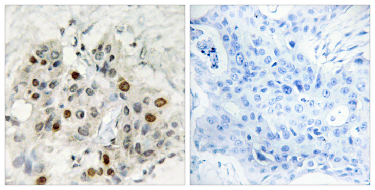 AFF1 / AF4 Antibody - Immunohistochemistry analysis of paraffin-embedded human breast carcinoma tissue, using AF4 Antibody. The picture on the right is blocked with the synthesized peptide.