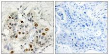 AFF1 / AF4 Antibody - Immunohistochemistry analysis of paraffin-embedded human breast carcinoma tissue, using AF4 Antibody. The picture on the right is blocked with the synthesized peptide.