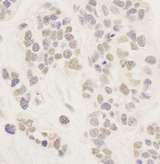 AFF1 / AF4 Antibody - Detection of Human AF4 by Immunohistochemistry. Sample: FFPE section of human breast carcinoma. Antibody: Affinity purified rabbit anti-AF4 used at a dilution of 1:1000 (1 ug/ml). Detection: DAB.