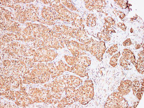 AFP Antibody - Immunohistochemistry of paraffin-embedded Human liver cancer using Afp Polyclonal Antibody at dilution of 1:200.