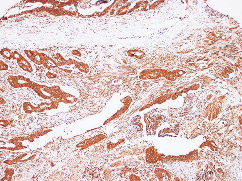 AFP Antibody - Immunohistochemistry of paraffin-embedded Human stomach cancer using AFP Polyclonl Antibody at dilution of 1:200(100×).