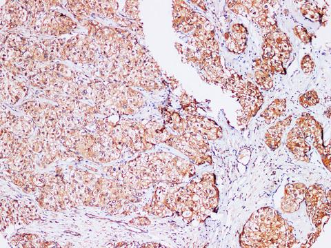 AFP Antibody - Immunohistochemistry of paraffin-embedded Human liver cancer using AFP Polyclonl Antibody at dilution of 1:200(100×).