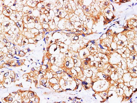 AFP Antibody - Immunohistochemistry of paraffin-embedded Human liver cancer using AFP Polyclonl Antibody at dilution of 1:200(400×).