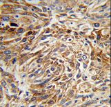 AG3 / AGR3 Antibody - Formalin-fixed and paraffin-embedded human lung carcinoma reacted with AGR3 Antibody , which was peroxidase-conjugated to the secondary antibody, followed by DAB staining. This data demonstrates the use of this antibody for immunohistochemistry; clinical relevance has not been evaluated.