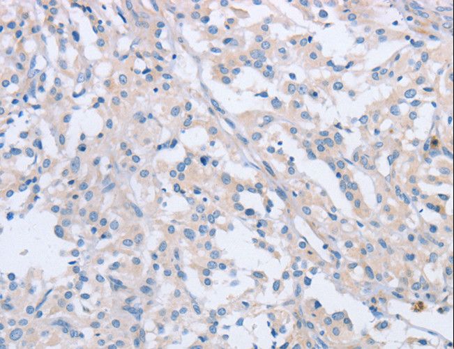 AGAP2 / PIKE Antibody - Immunohistochemistry of paraffin-embedded Human thyroid cancer using AGAP2 Polyclonal Antibody at dilution of 1:60.