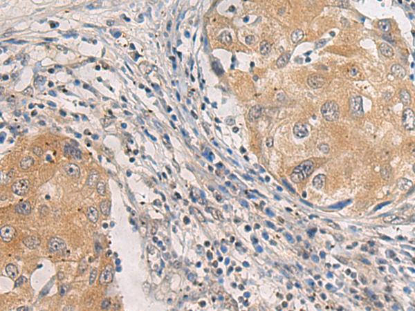 AGAP3 / CENTG3 / MRIP-1 Antibody - Immunohistochemistry of paraffin-embedded Human breast cancer tissue  using AGAP3 Polyclonal Antibody at dilution of 1:25(×200)