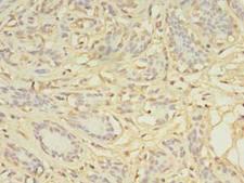 AGBL2 / CCP2 Antibody - Immunohistochemistry of paraffin-embedded human breast cancer tissue using antibody at 1:100 dilution.