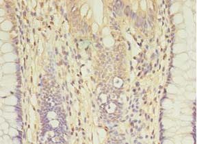 AGBL2 / CCP2 Antibody - Immunohistochemistry of paraffin-embedded human colon cancer tissue using antibody at 1:100 dilution.