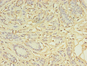AGBL2 / CCP2 Antibody - Immunohistochemistry of paraffin-embedded human breast cancer using AGBL2 Antibody at dilution of 1:100