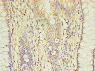 AGBL2 / CCP2 Antibody - Immunohistochemistry of paraffin-embedded human colon cancer using AGBL2 Antibody at dilution of 1:100