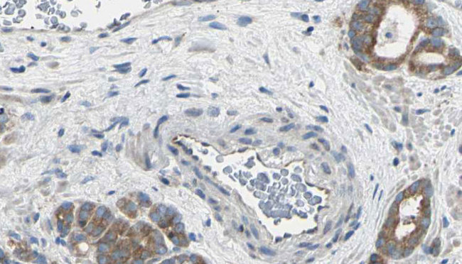 AGBL2 / CCP2 Antibody - 1:100 staining human prostate tissue by IHC-P. The sample was formaldehyde fixed and a heat mediated antigen retrieval step in citrate buffer was performed. The sample was then blocked and incubated with the antibody for 1.5 hours at 22°C. An HRP conjugated goat anti-rabbit antibody was used as the secondary.