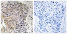 AGBL3 Antibody - Immunohistochemistry analysis of paraffin-embedded human lung carcinoma, using CBCP3 Antibody. The picture on the right is blocked with the synthesized peptide.