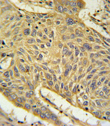 AGER / RAGE Antibody - AGER Antibody IHC of formalin-fixed and paraffin-embedded human lung carcinoma followed by peroxidase-conjugated secondary antibody and DAB staining.
