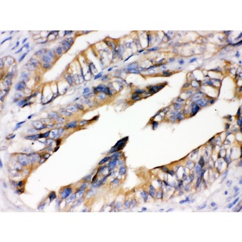 AGER / RAGE Antibody - RAGE antibody IHC-paraffin. IHC(P): Human Intestinal Cancer Tissue.