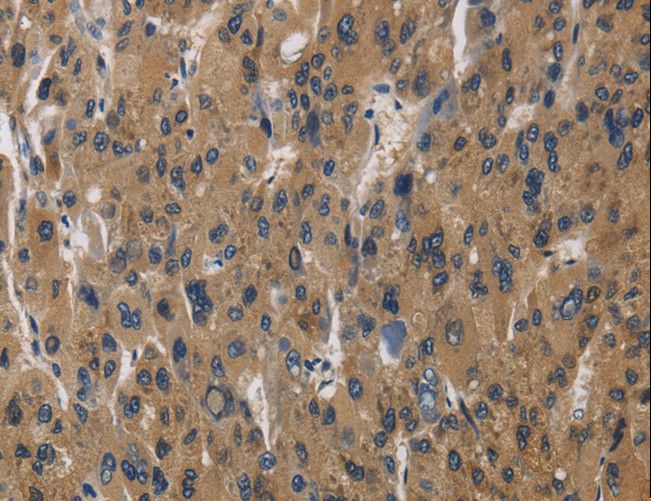 AGER / RAGE Antibody - Immunohistochemistry of paraffin-embedded Human liver cancer using AGER Polyclonal Antibody at dilution of 1:70.
