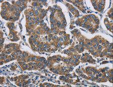 AGER / RAGE Antibody - Immunohistochemistry of paraffin-embedded Human breast cancer using AGER Polyclonal Antibody at dilution of 1:70.
