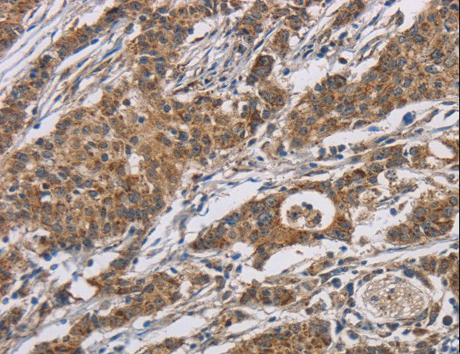 AGER / RAGE Antibody - Immunohistochemistry of paraffin-embedded Human gastric cancer using AGER Polyclonal Antibody at dilution of 1:70.
