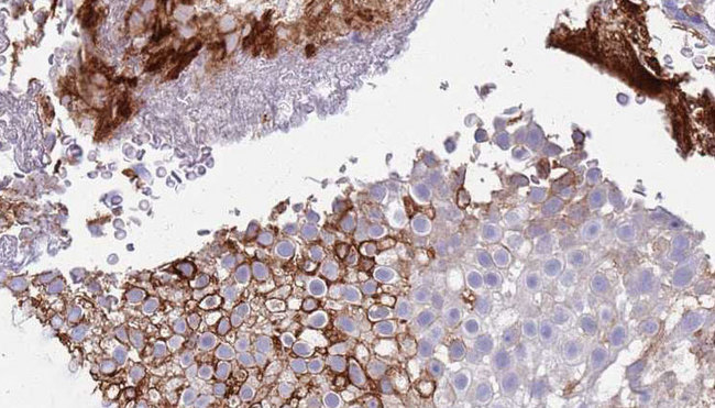 AGER / RAGE Antibody - 1:100 staining human urothelial carcinoma tissue by IHC-P. The sample was formaldehyde fixed and a heat mediated antigen retrieval step in citrate buffer was performed. The sample was then blocked and incubated with the antibody for 1.5 hours at 22°C. An HRP conjugated goat anti-rabbit antibody was used as the secondary.