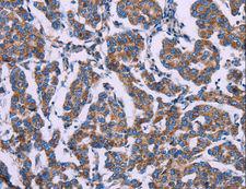 AGFG1 Antibody - Immunohistochemistry of paraffin-embedded Human breast cancer using AGFG1 Polyclonal Antibody at dilution of 1:50.