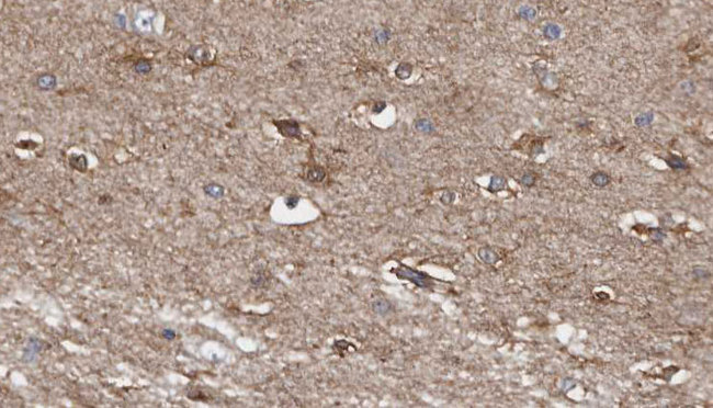 AGK Antibody - 1:100 staining human brain carcinoma tissue by IHC-P. The sample was formaldehyde fixed and a heat mediated antigen retrieval step in citrate buffer was performed. The sample was then blocked and incubated with the antibody for 1.5 hours at 22°C. An HRP conjugated goat anti-rabbit antibody was used as the secondary.