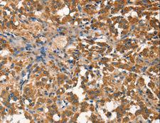 AGO1 / EIF2C Antibody - Immunohistochemistry of paraffin-embedded Human cervical cancer using AGO1 Polyclonal Antibody at dilution of 1:40.