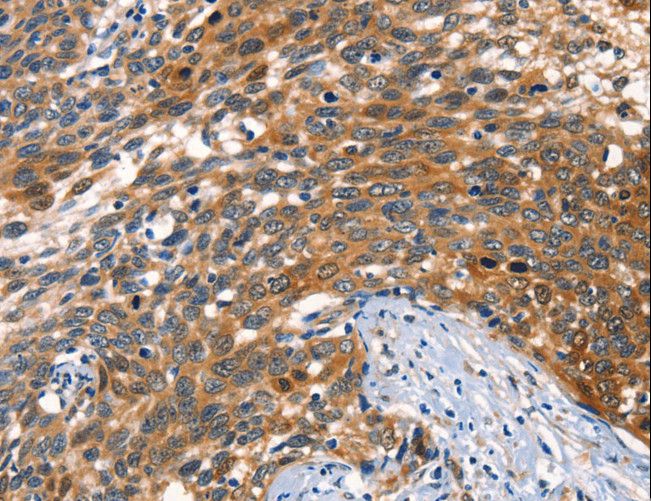 AGO1 / EIF2C Antibody - Immunohistochemistry of paraffin-embedded Human cervical cancer using AGO1 Polyclonal Antibody at dilution of 1:40.