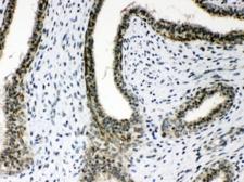 AGO1 / EIF2C Antibody - IHC testing of FFPE human breast cancer tissue with AGO1 antibody at 1ug/ml. Required HIER: steam section in pH6 citrate buffer for 20 min and allow to cool prior to testing.
