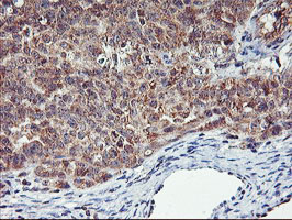 AGPAT5 Antibody - IHC of paraffin-embedded Adenocarcinoma of Human ovary tissue using anti-AGPAT5 mouse monoclonal antibody.