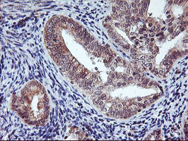 AGPAT5 Antibody - IHC of paraffin-embedded Adenocarcinoma of Human endometrium tissue using anti-AGPAT5 mouse monoclonal antibody.