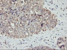AGPAT5 Antibody - IHC of paraffin-embedded Adenocarcinoma of Human ovary tissue using anti-AGPAT5 mouse monoclonal antibody.