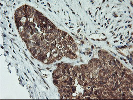 AGPAT5 Antibody - IHC of paraffin-embedded Adenocarcinoma of Human ovary tissue using anti-AGPAT5 mouse monoclonal antibody.