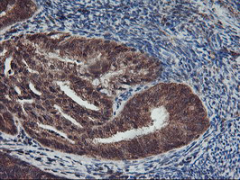 AGPAT5 Antibody - IHC of paraffin-embedded Adenocarcinoma of Human endometrium tissue using anti-AGPAT5 mouse monoclonal antibody.