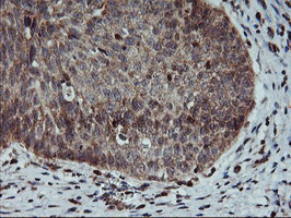 AGPAT5 Antibody - IHC of paraffin-embedded Carcinoma of Human bladder tissue using anti-AGPAT5 mouse monoclonal antibody.