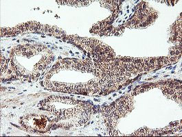 AGPAT5 Antibody - IHC of paraffin-embedded Carcinoma of Human prostate tissue using anti-AGPAT5 mouse monoclonal antibody.