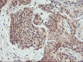AGPAT5 Antibody - IHC of paraffin-embedded Carcinoma of Human bladder tissue using anti-AGPAT5 mouse monoclonal antibody.