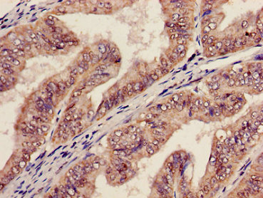 AGPAT5 Antibody - Immunohistochemistry image of paraffin-embedded human endometrial cancer at a dilution of 1:100