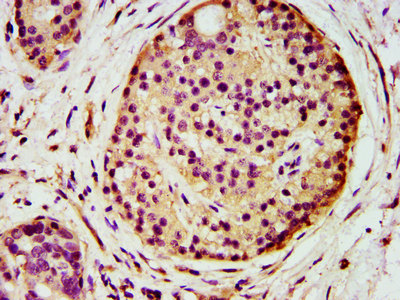 AGPS Antibody - Immunohistochemistry image at a dilution of 1:500 and staining in paraffin-embedded human pancreatic cancer performed on a Leica BondTM system. After dewaxing and hydration, antigen retrieval was mediated by high pressure in a citrate buffer (pH 6.0) . Section was blocked with 10% normal goat serum 30min at RT. Then primary antibody (1% BSA) was incubated at 4 °C overnight. The primary is detected by a biotinylated secondary antibody and visualized using an HRP conjugated SP system.