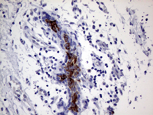 AGR2 Antibody - Immunohistochemical staining of paraffin-embedded Human breast tissue within the normal limits using anti-AGR2 mouse monoclonal antibody. (Heat-induced epitope retrieval by 1mM EDTA in 10mM Tris buffer. (pH8.5) at 120°C for 3 min. (1:500)