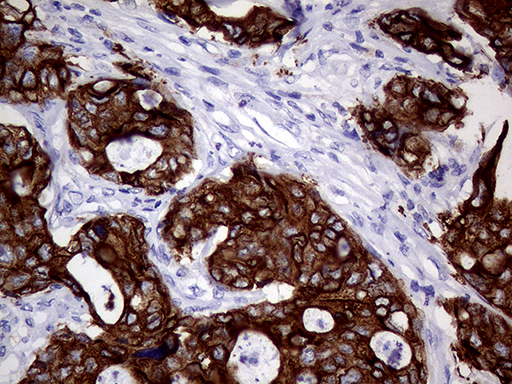 AGR2 Antibody - Immunohistochemical staining of paraffin-embedded Adenocarcinoma of Human breast tissue tissue using anti-AGR2 mouse monoclonal antibody. (Heat-induced epitope retrieval by 1mM EDTA in 10mM Tris buffer. (pH8.5) at 120°C for 3 min. (1:500)