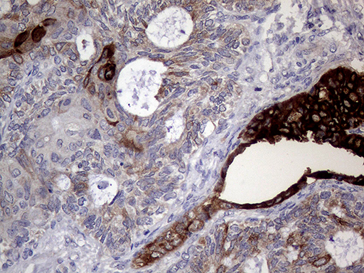AGR2 Antibody - Immunohistochemical staining of paraffin-embedded Adenocarcinoma of Human ovary tissue using anti-AGR2 mouse monoclonal antibody. (Heat-induced epitope retrieval by 1mM EDTA in 10mM Tris buffer. (pH8.5) at 120°C for 3 min. (1:500)