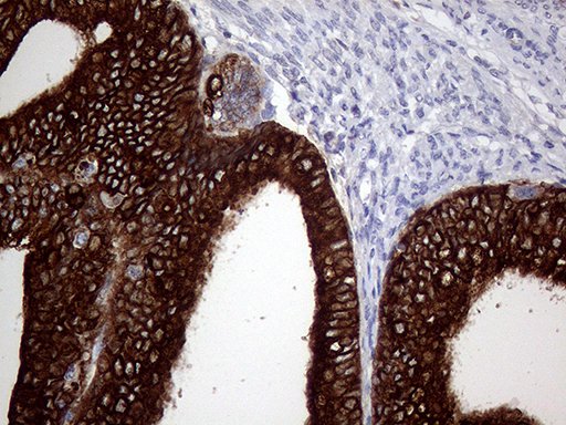 AGR2 Antibody - Immunohistochemical staining of paraffin-embedded Adenocarcinoma of Human endometrium tissue using anti-AGR2 mouse monoclonal antibody. (Heat-induced epitope retrieval by 1mM EDTA in 10mM Tris buffer. (pH8.5) at 120°C for 3 min. (1:500)