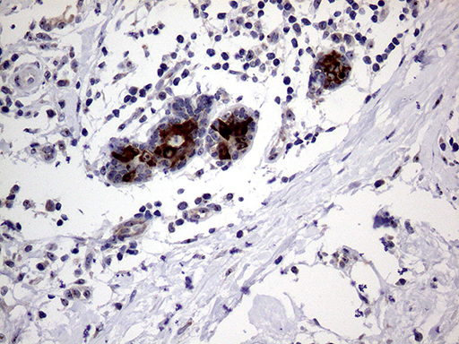 AGR2 Antibody - Immunohistochemical staining of paraffin-embedded Human breast tissue within the normal limits using anti-AGR2 mouse monoclonal antibody. (Heat-induced epitope retrieval by 1mM EDTA in 10mM Tris buffer. (pH8.5) at 120°C for 3 min. (1:500)